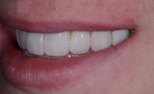 Close-up of a smile with bright white dental veneers on upper teeth.