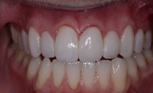 Close-up of a smile with straight, white teeth and pink gums.