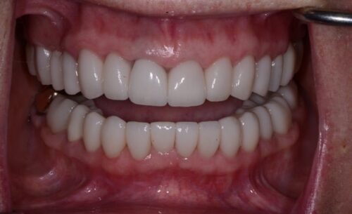 Close-up of a mouth wearing full upper and lower dentures, showing even white teeth and pink gums. (Informative image: full denture prostheses on both arches)