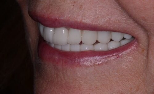 Close-up of a smiling mouth showing white, evenly aligned teeth and pink lips.