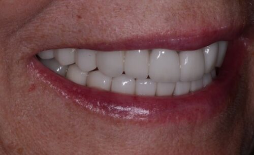 Close-up of a smiling mouth showing bright white, evenly aligned teeth with pink lips safe for a dental context
