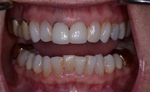 Close-up of a mouth with both upper and lower teeth visible; upper teeth appear uniform white (likely crowns/veneers) while lower teeth show natural wear; pink gums.