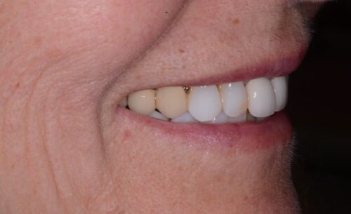 Close-up profile of a smiling mouth showing white dental veneers on the front teeth and darker natural teeth beside them.