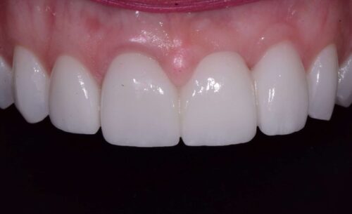 Close-up of upper front teeth showing dental veneers or crowns and pink gum tissue behind them, with a dark background for contrast.