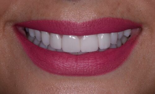 Close-up of a smile with pink lipstick, showing white, well-aligned teeth in the foreground.