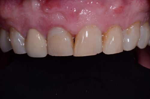 Close-up of the upper front teeth showing a gap (diastema) and mildly inflamed pink gums.