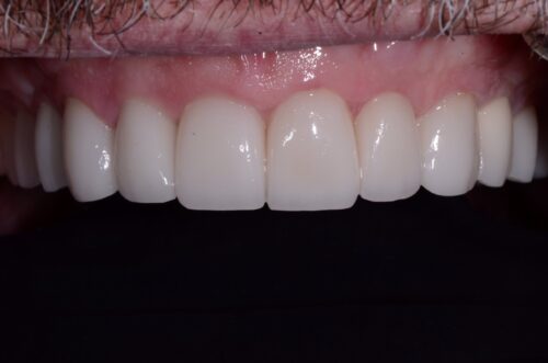 Close-up of upper front teeth and gums showing mild redness along the gumline and healthy-looking teeth