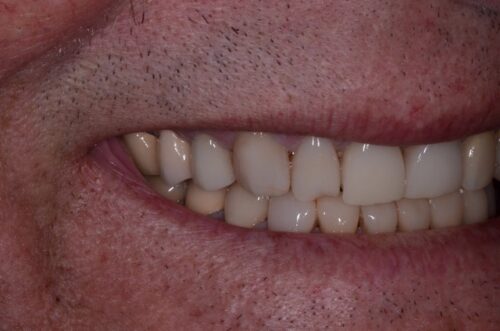 Close-up of a smiling mouth showing upper and lower teeth with lips partially open.