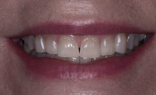 Close-up of a smile showing upper and lower teeth with lips slightly parted and pink lipstick/barrier on lips visible? (smile)