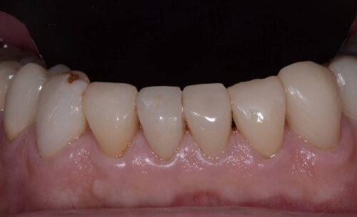 Close-up of the lower front teeth and gums, showing small gaps and contact points between teeth.