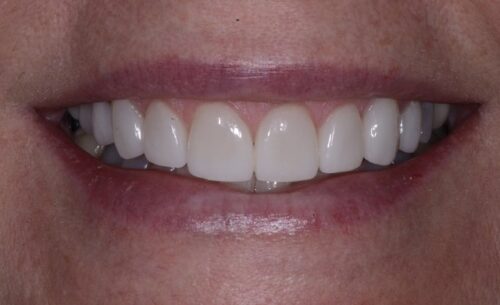 Close-up of a smiling mouth showing straight, white teeth and pink lips.