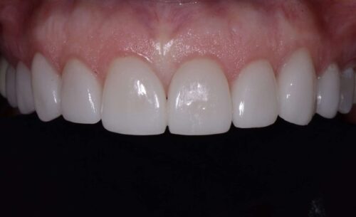 Close-up of the upper front teeth with uniform white veneers and pink gums visible behind them