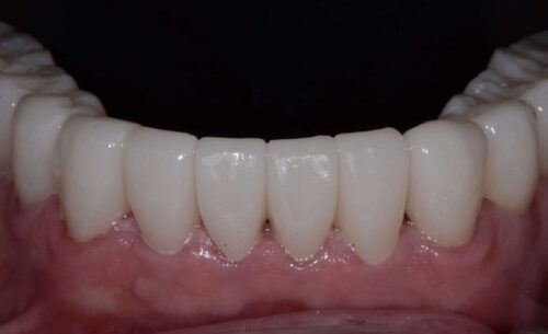 Close-up of lower front teeth and pink gums; appears to be a dental denture or bridge, very white and evenly aligned.