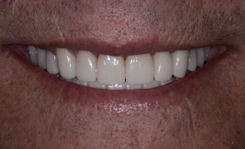 Close-up of a wide, white smile showing even upper teeth and pink lips.
