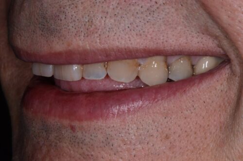 Close-up of a man's mouth showing upper teeth that are yellowed and stained with minor wear along the gumline.