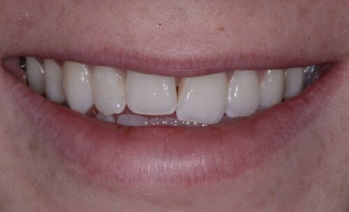 Close-up of a smile showing bright, white teeth with a small gap between the two front teeth.