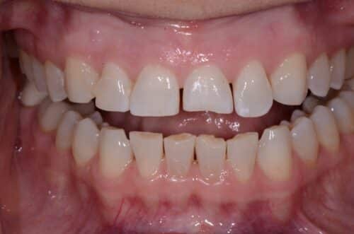 Front view of the mouth showing a gap between the upper front teeth and crowding of the lower front teeth.