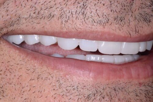 Close-up of a mouth in a smile, showing bright white teeth and pink lips with facial stubble nearby.