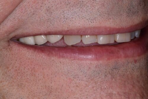 Close-up of a smiling mouth showing upper teeth with slight gaps and uneven edges, lips partially closed over the teeth.