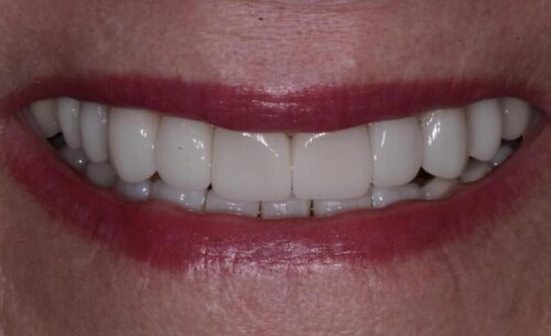 Close-up of a smiling mouth showing straight, white teeth and pink lips in a friendly grin.