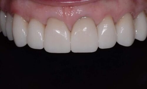 Close-up of the upper front teeth with bright, uniform veneers/call crowns and pink gums visible above them