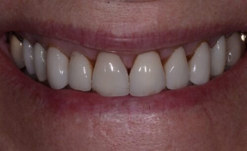 Close-up of a smile with bright white, evenly shaped upper front teeth.
