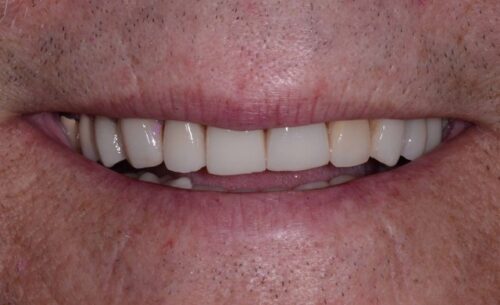 Close-up of a smiling mouth showing upper teeth with uniform white veneers, pink lips, and visible skin texture around the mouth.