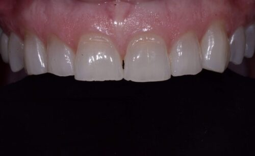 Close-up of the upper front teeth and gums, showing a small gap between the two central incisors (diastema).