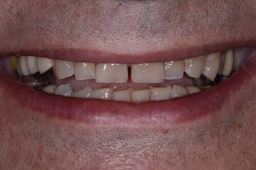 Close-up of a mouth showing upper teeth with a noticeable gap between the front teeth and uneven alignment.