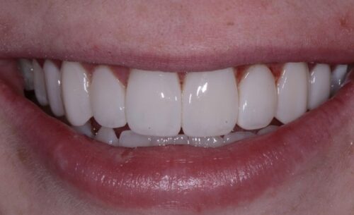 Close-up of a smile showing white, evenly spaced teeth with pink lips framing the mouth.